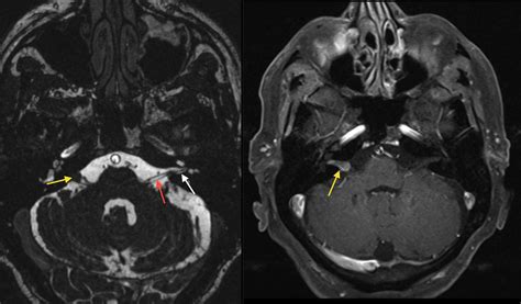 Acoustic Neuroma Radiology At St Vincents University Hospital