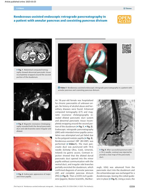 Pdf Rendezvous Assisted Endoscopic Retrograde Pancreatography In A