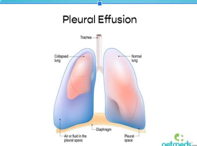 Pleural Effusion Flashcards Quizlet