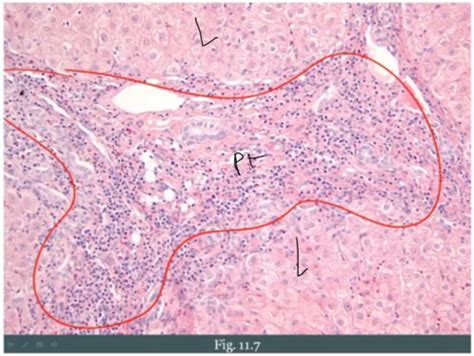 Pathology Of The Liver Hepatitis Flashcards Quizlet