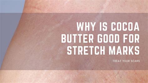 Why Is Cocoa Butter Good For Stretch Marks Treat Your Scars