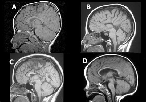 T Weighted Midsaggital Mr Imaging Of Brain A Radiologically Normal