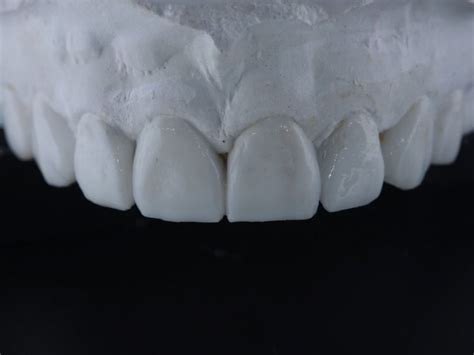 Facial Radiologia O que é copia de gesso dentária