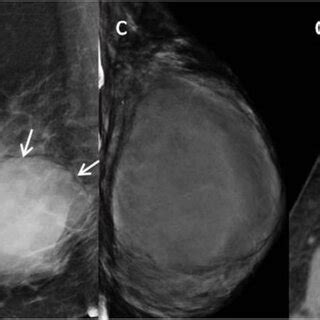 A B Benign Phyllodes Tumor Pt Of Left Breast In Year Old Woman