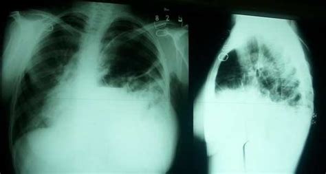 showing scaphoid abdomen . bowel sound in the left side of chest ...