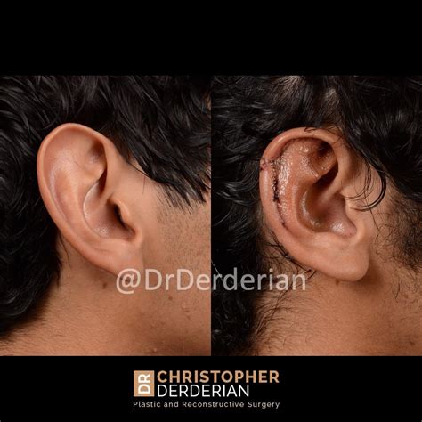 Reduction Otoplasty — Dr Derderian — Plastic and Reconstructive Surgery