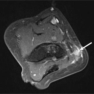 Contrast Enhanced T Weighted Axial Image Demonstrated An Enhanced