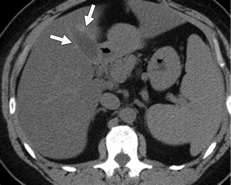 Detection Of Hepatic Steatosis On Contrast Enhanced CT Images