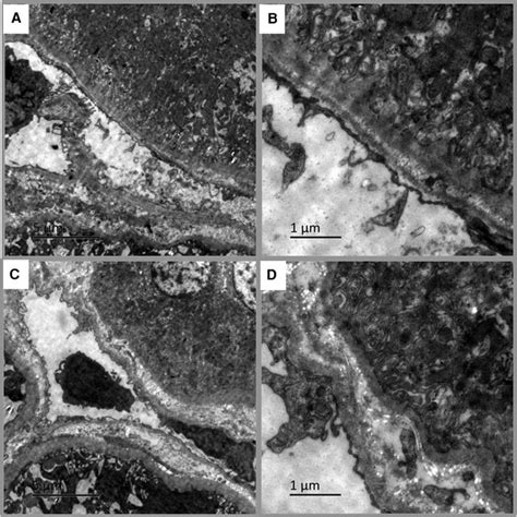 Transmission Electron Microscopy In Pediatric Lupus Nephritis Ln