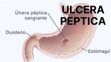 Úlcera Péptica ROMY SOLANGE MARTEL ARNAO uDocz