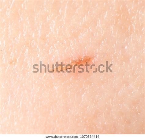 Wound On Human Skin Background Stock Photo 1070534414 Shutterstock