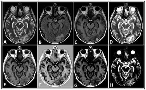 Representative Mri Data Of A 40 Year Old Male Bm Patient Treated With Download Scientific