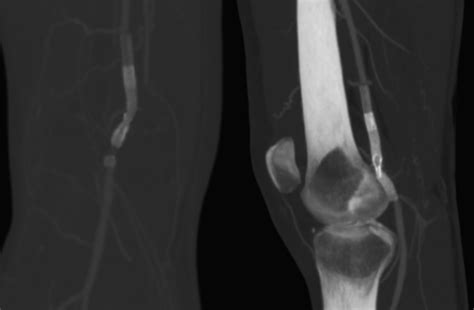 Endovascular Treatment Of Popliteal Artery Occlusion Caused By A