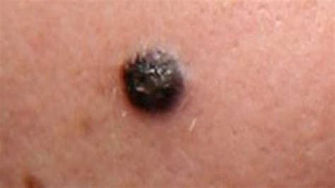 Pictures of Nodular Melanoma