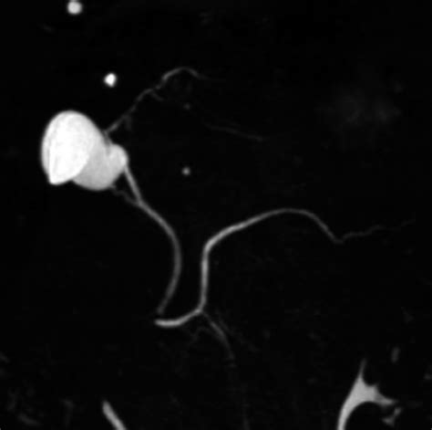 Pancreas Divisum With Main Pancreatic Duct And Duct Of Santorini In