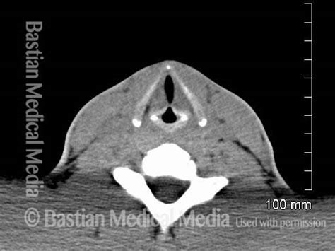 Pyriform Sinus Laryngeal Anatomy With Pictures