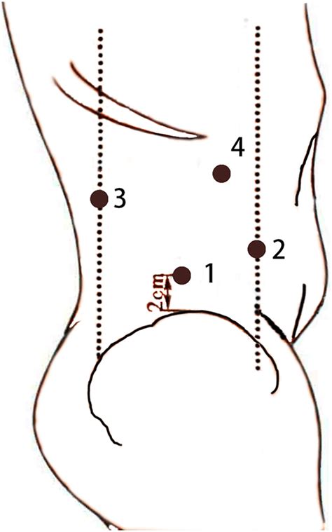 Trocar positions. Note that: #1 which on the mid-axillary line, 2 cm ...