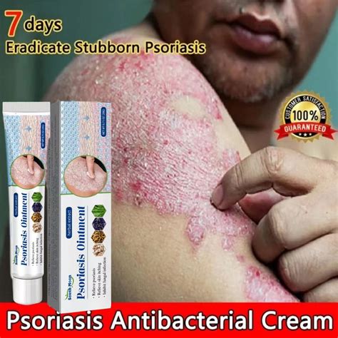 Krim Perawatan Anti Eksim Psoriasis Bulan Selatan Dan Eksim Dengan