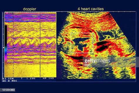 Cardiac Doppler Ultrasound Fotografías E Imágenes De Stock Getty Images