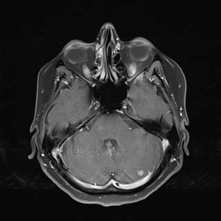 Pituitary Metastasis Image Radiopaedia Org