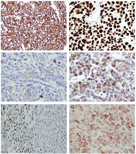 The Neoplastic Cells Exhibited B Cell Lineage Immunophenotype The