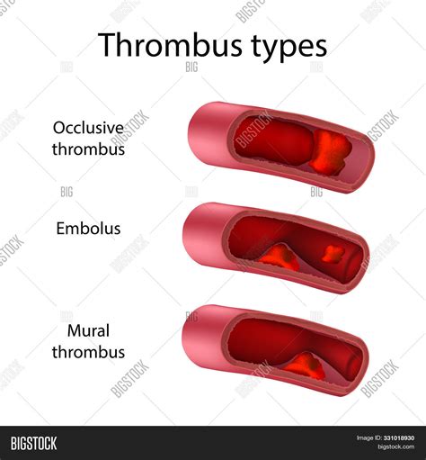 Thrombus Types, Image & Photo (Free Trial) | Bigstock