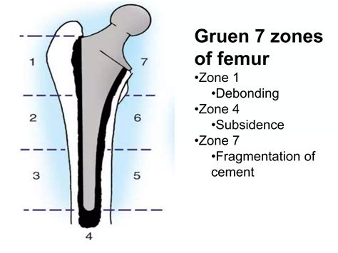 Aseptic Loosening Total Hip Arthroplasty Ppt