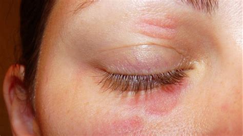 Eye Rash On Eyelids Pictures Photos