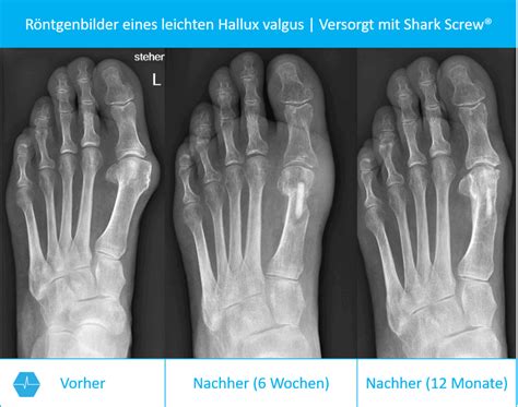 Hallux Valgus OP Erfahrungen Risiken Chance Methoden Operation