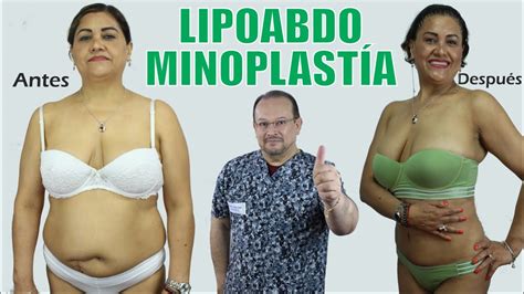 LIPOaBDOmINOPLAsTIA CasO ReaL Lipotransferencia Glúteos Abdomen