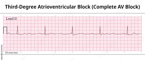 Ecg Third Degree Atrioventricular Block Complete Av Block Second