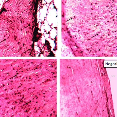 IHC Nuclear Staining Of MMP 9 In Preparations Of Human Abdominal