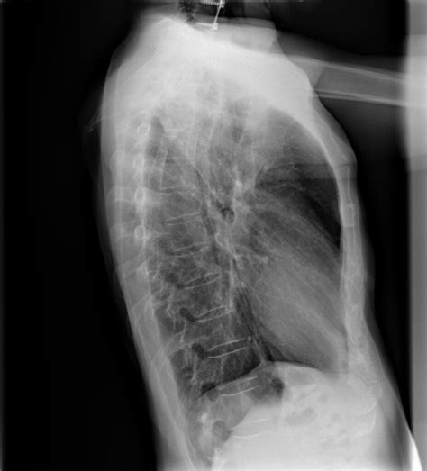 Radiografia Lateral De Torax