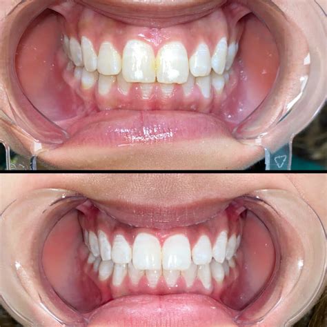 Laser Teeth Whitening In Grand Junction Colorado