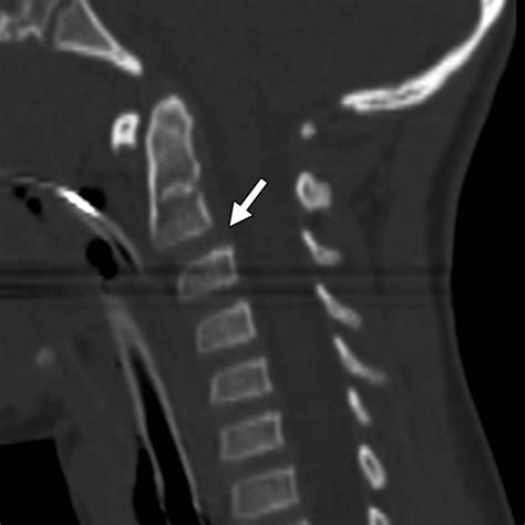 Imaging Of Trauma Part 1 Pseudotrauma Of The Spineosseous Variants