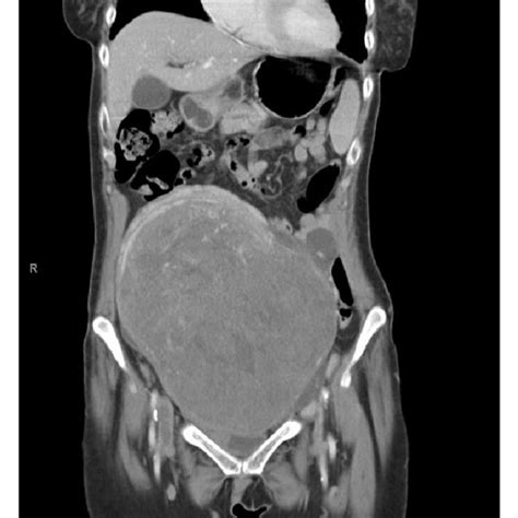 Abdomen Pelvis Ct Scan Of Case Showing Large Uterine Leiomyoma