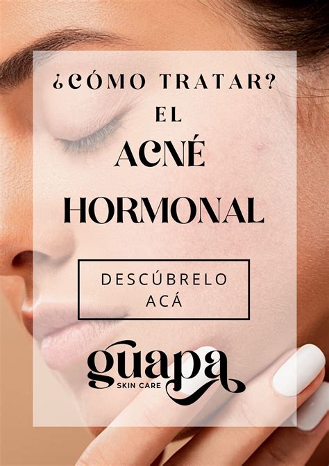 Acné Hormonal ¿qué Es Y Cómo Tratarlo Guapa Skincare Acné Hormonal