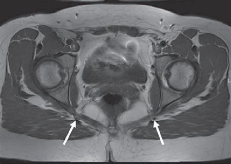 Normal Pudendal Nerve Axial T1 Image Shows Normal Appearance Of The