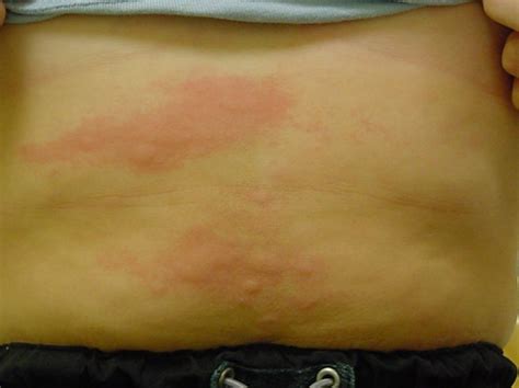 Erythema Multiforme Diseases And Conditions 5minuteconsult