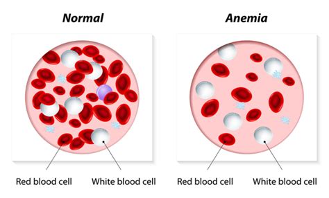 Abetalipoproteinemia: MedlinePlus Genetics