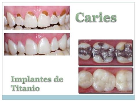 Composites Dentales PPT