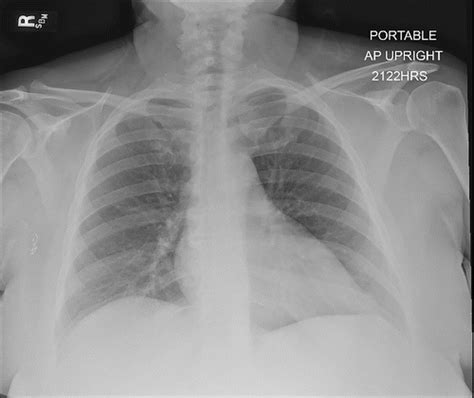 Portable Chest Radiography Must Know Findings And Mimics Radiographics