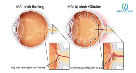 Đau hốc mắt là dấu hiệu cảnh báo bệnh gì Cần xử lý như thế nào