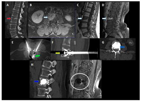 Jcm Free Full Text Percutaneous Vertebral Reconstruction Pvr