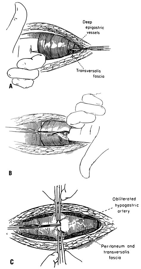 Transversalis Fascia Defects