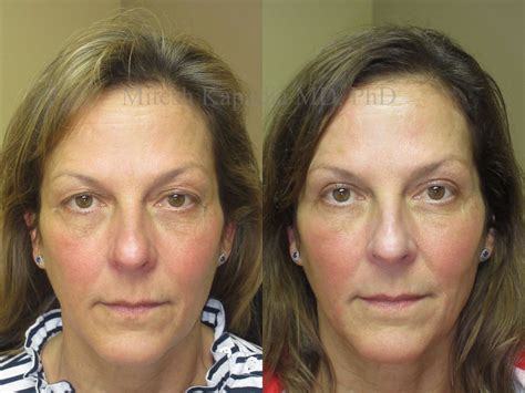 Upper Blepharoplasty Before And After Photos Boston Eyelid Surgery