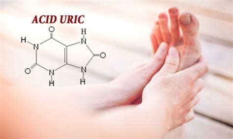 Chỉ số Acid uric cao bao nhiêu thì bị gout