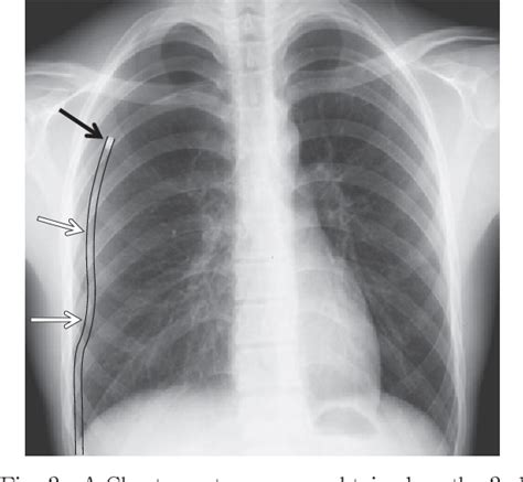 PDF A Case Of Chylothorax Causing To Chest Tube Insertion For