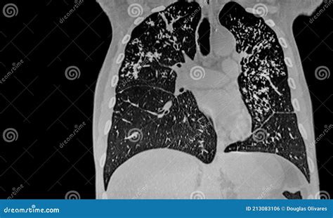 TAC De Paciente Con Infección Por Tuberculosis. Foto de archivo ...