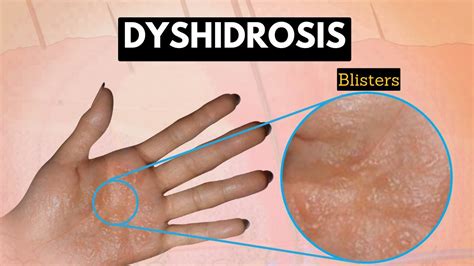 Dyshidrosis Causes Signs And Symptoms Diagnosis And Treatment YouTube